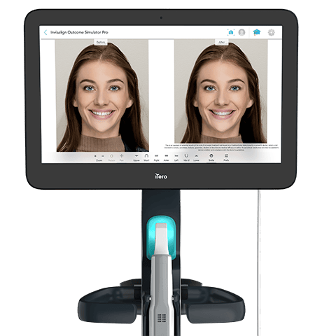 Invisalign Outcome Simulator